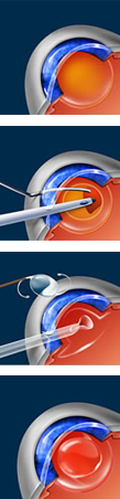 Four images showing illustration of the eye with different steps involved with cataract surgery